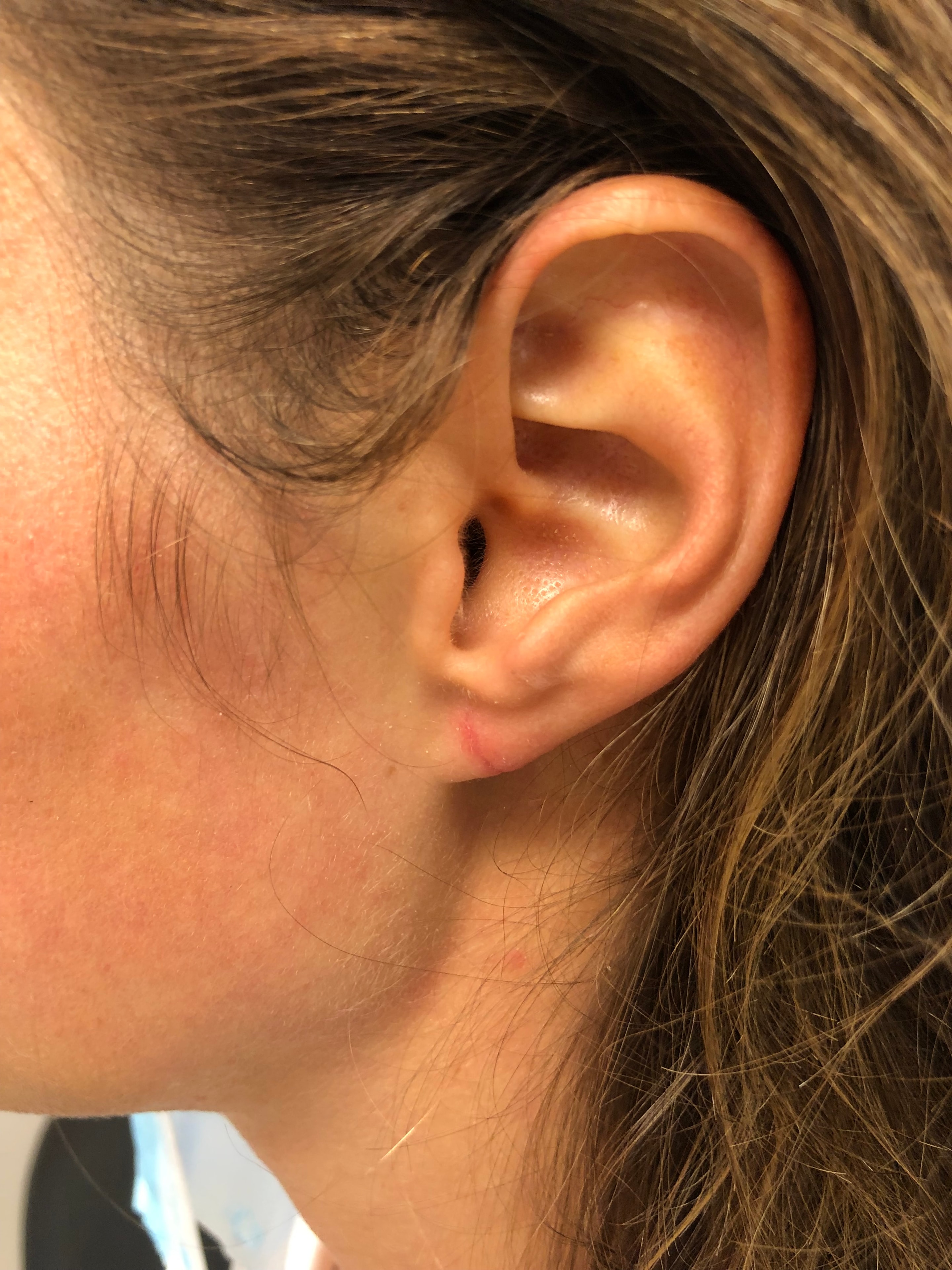 Earlobe after gauge repair — restored natural shape