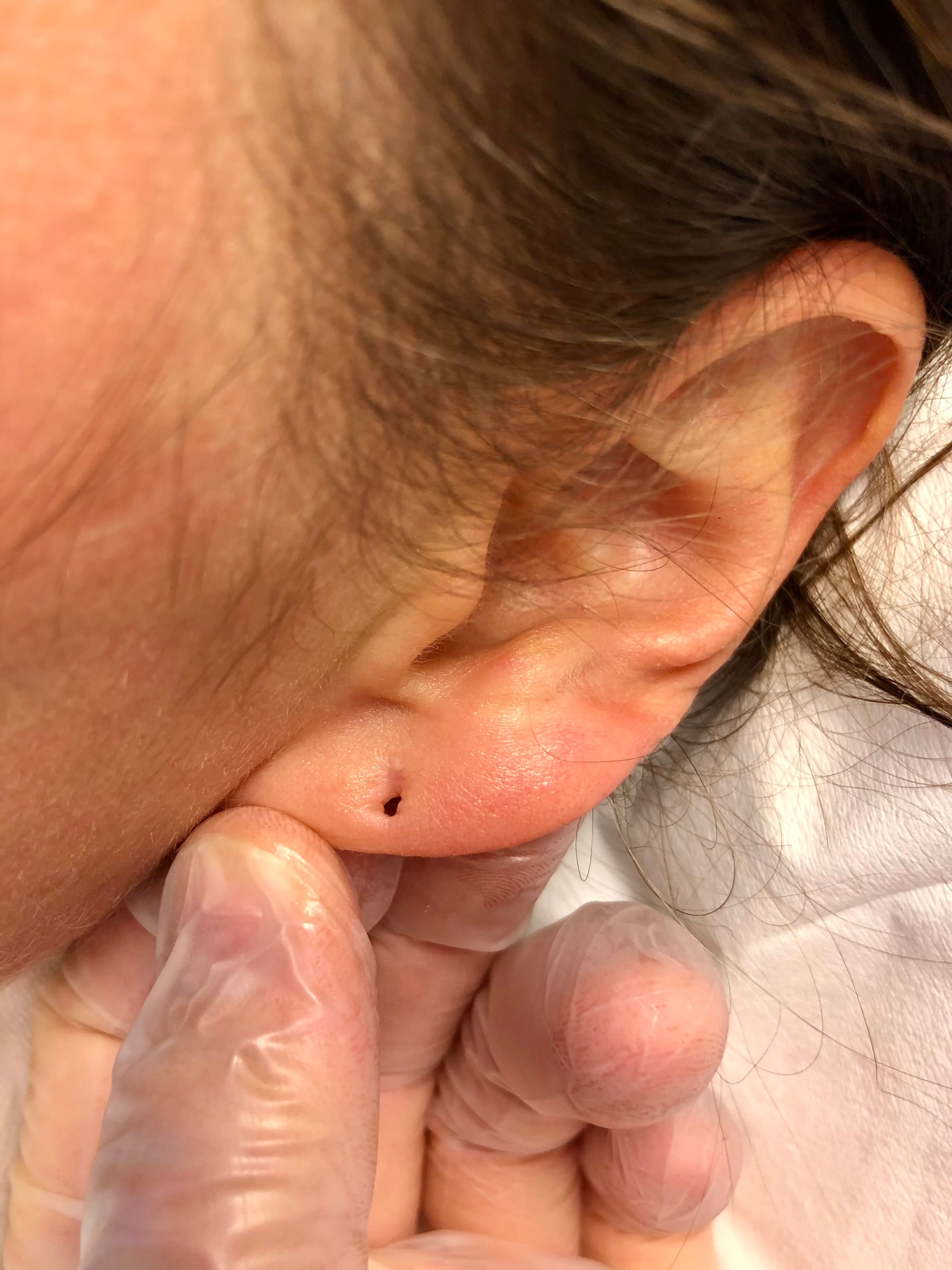 Earlobe before gauge repair procedure
