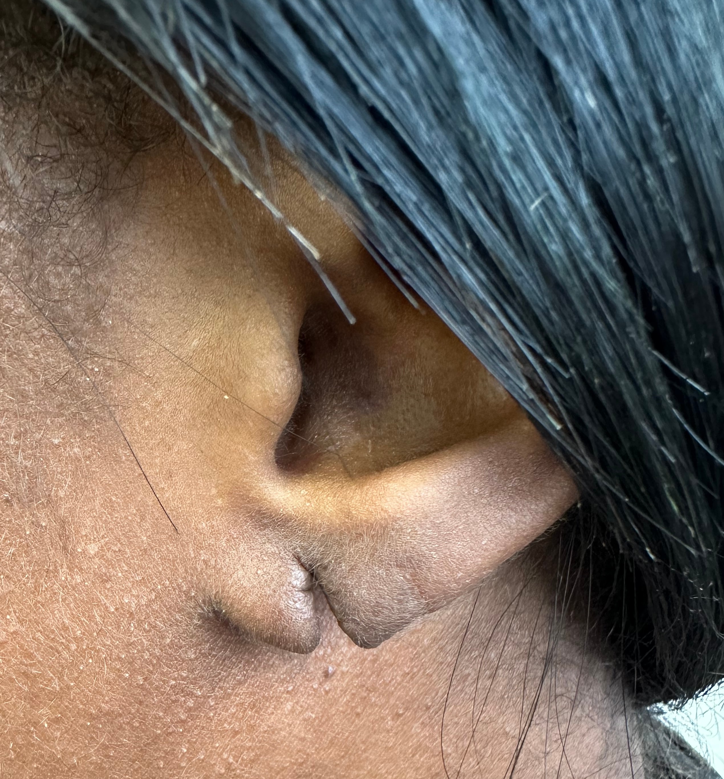Earlobe before re-piercing