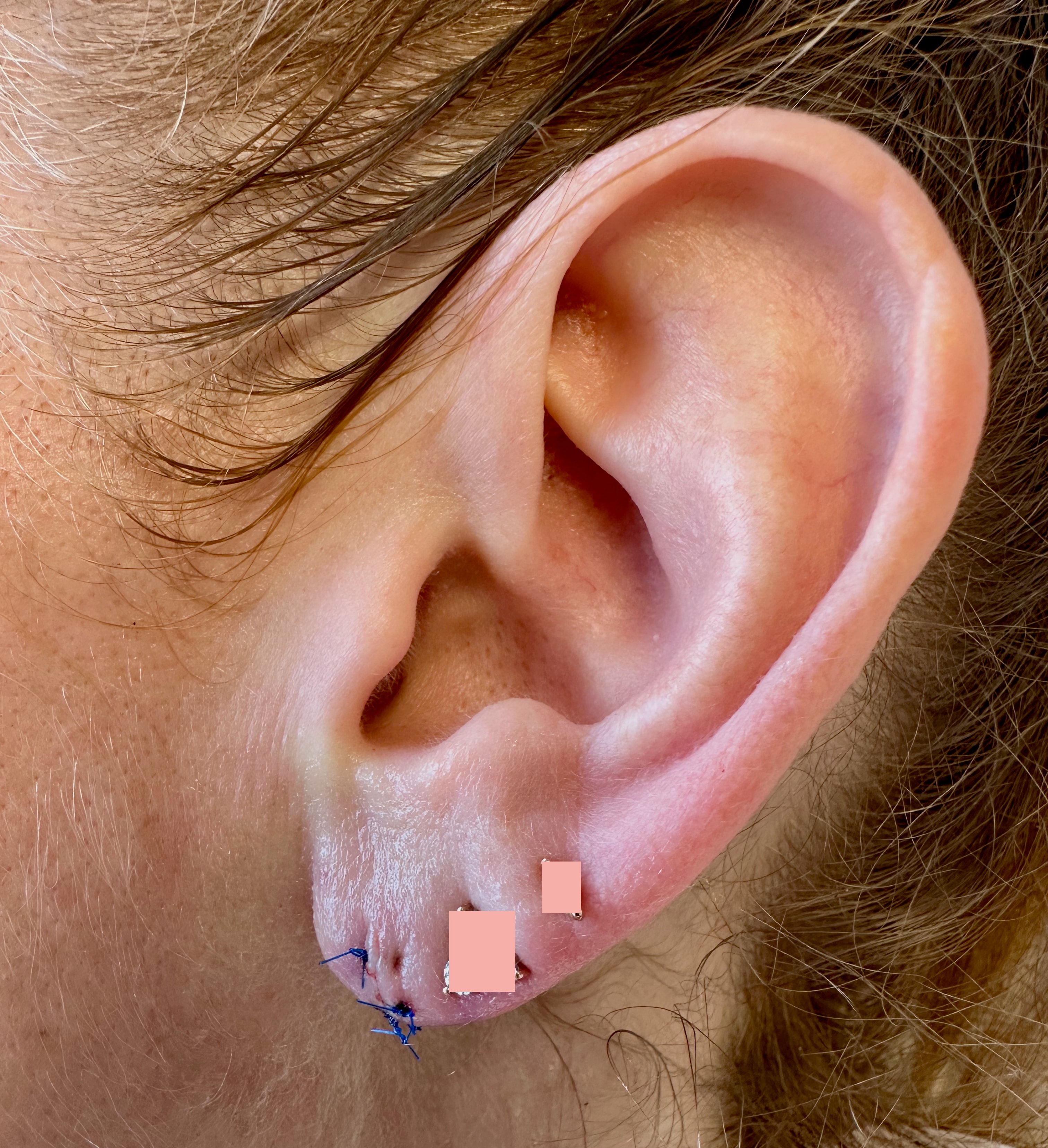 Earlobe after torn earlobe repair — natural, healed result