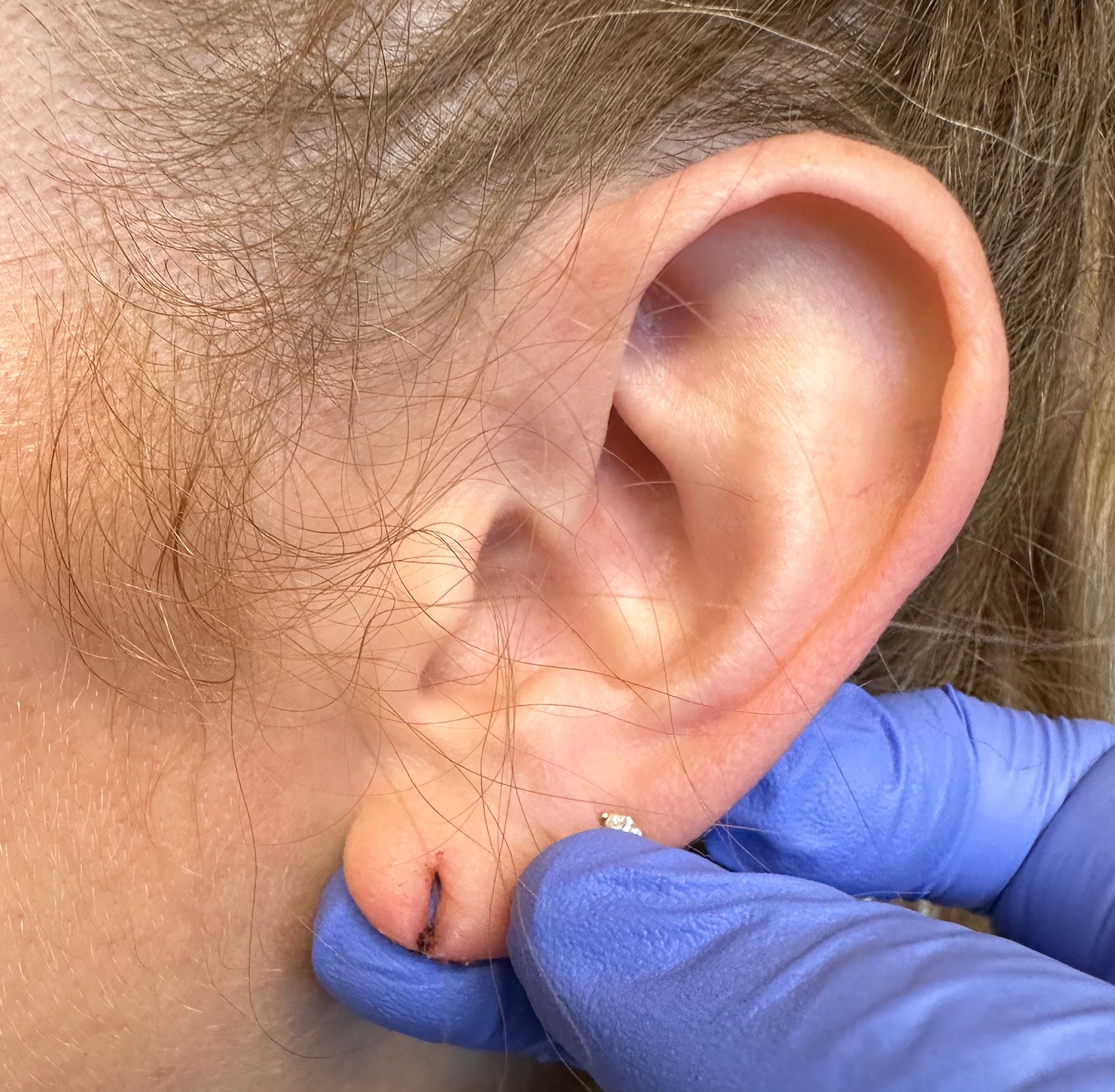 Earlobe before torn earlobe repair procedure